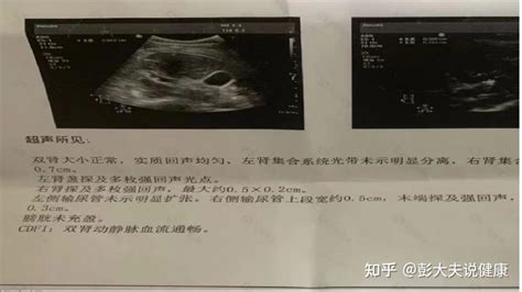 肾结石最有效的排石方法——真实案例分享 知乎