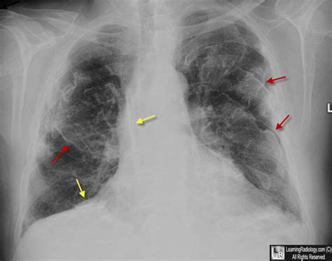 Non Calcified Pleural Plaques