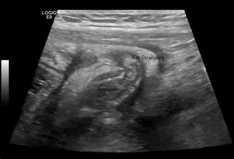 Appendix Ultrasound – Sonographic Tendencies