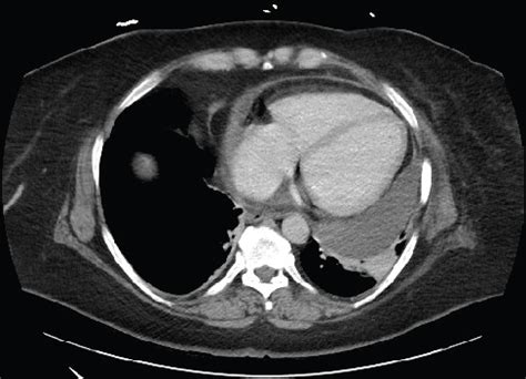 Recurrent Pericardial Effusion Following Diaphragmatic Hernia Repair