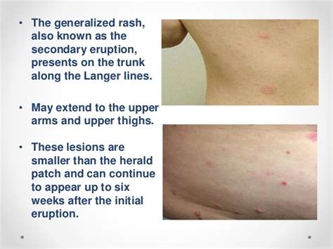 Pityriasis Rosea Rash Description