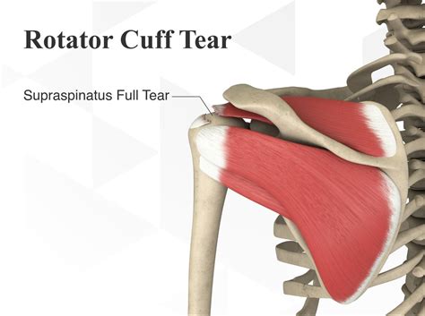 Rotator Cuff Tears Complete Physio