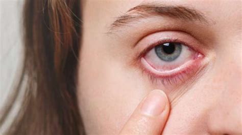 Delhi Sees Surge In Conjunctivitis Cases Know Causes And Treatments Of