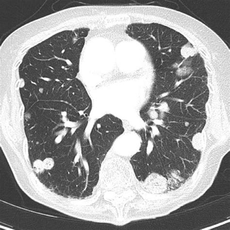 Multiple pulmonary metastases in a 75-year-old female patient with ...