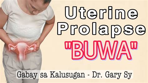 Uterine Prolapse Buwa Dr Gary Sy Youtube