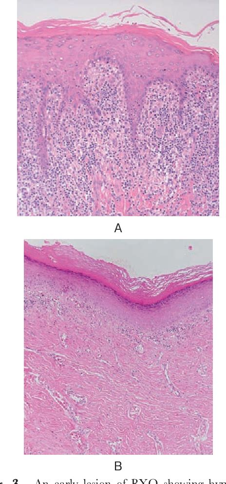 Balanitis Xerotica Obliterans Histology