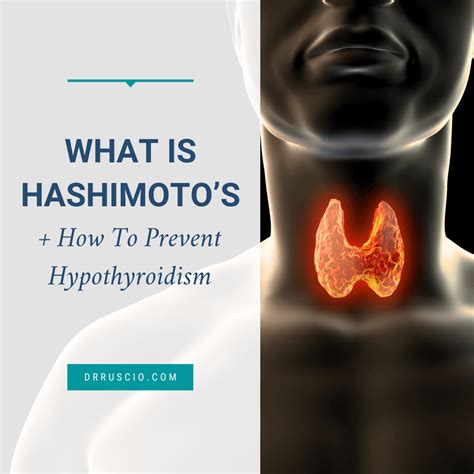 What Is Hashimoto’s + How To Prevent Hypothyroidism - Dr. Michael ...