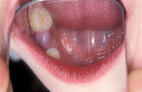 Floor Of Mouth Dermoid Cyst