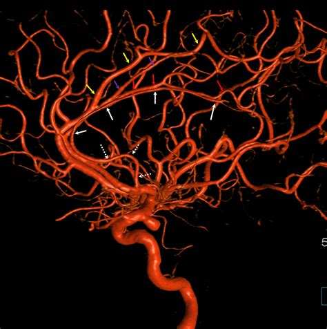 Anterior Cerebral Artery