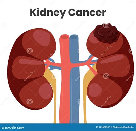 Illustration De Vecteur Du Cancer De Rein La Tumeur Affecte Le Rein