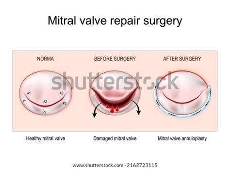 Mitral Valve Repair: Over 76 Royalty-Free Licensable Stock Vectors ...