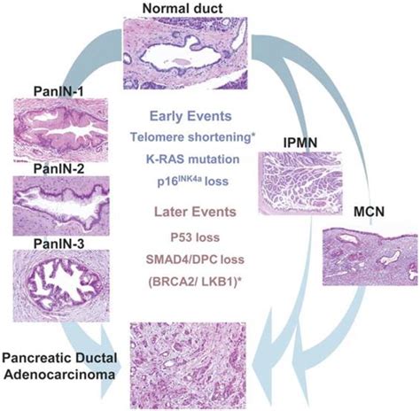 Cancer Of The Pancreas Molecular Pathways And Current Advancement In