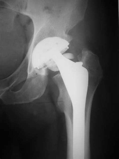 Revision Total Hip Arthroplasty For Ceramic Head Fracture The Journal