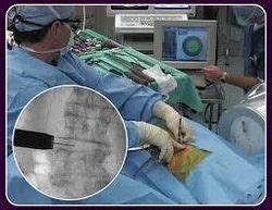 Spine Surgery XLIF, Spine Surgery Services - Spine Surgery India, New ...