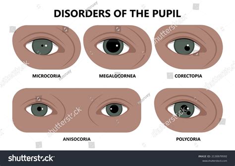 Miosis Eye Pupil Size Iris Retina Stock Vector (Royalty Free ...