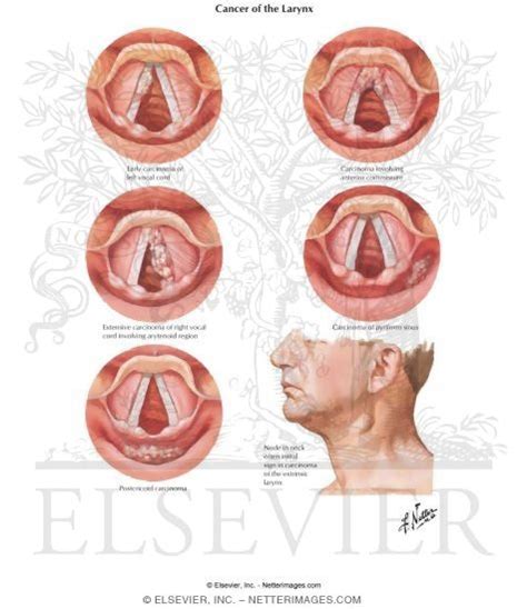 Cancer of the Larynx