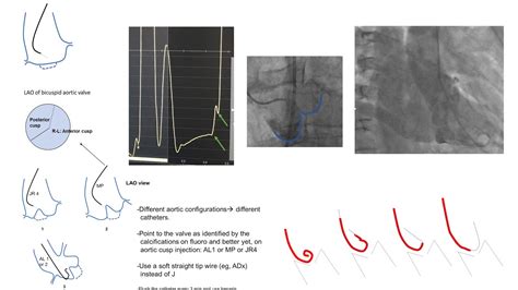 Left Ventricular Catheterization Including As And Left Ventriculography Diagrams And Cases