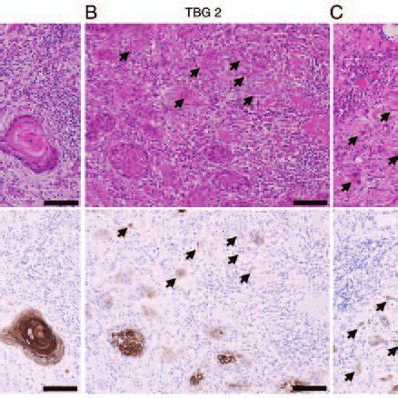 Scoring Of PDPN In Tumor Budding Cells By Immunohistochemical Stain