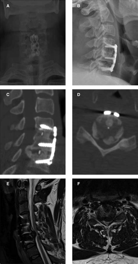 Cervical Osteophytes