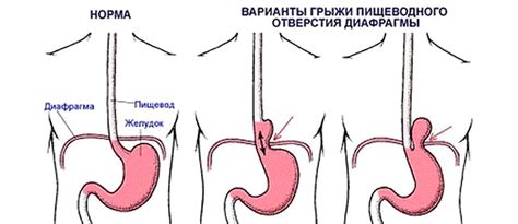 Грыжа диафрагмы пищеводного отверстия: симптомы и лечение