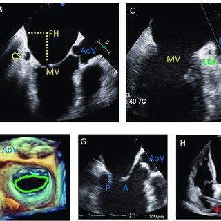 transesophageal echocardiogram tee pre procedural assessment
