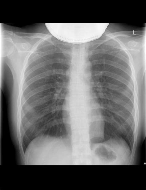 Chest X Ray Rpulmonology