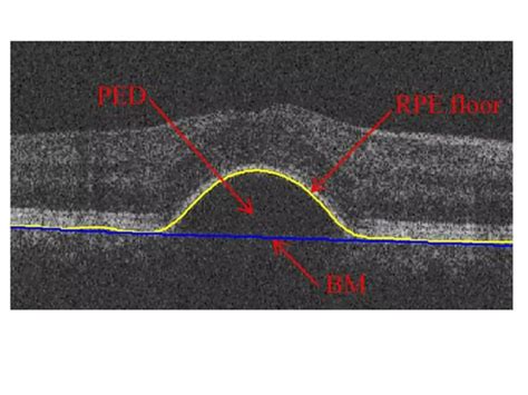 Pigment epithelial detachment (PED) | PPTX