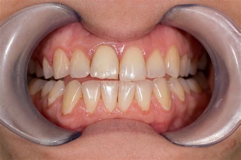 Gum Contouring Faq Greenspoint Dental Houston Dentist