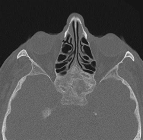 Sphenoid Bone Dysplasia