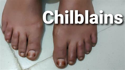 Red, Swollen, Itchy Toes - Chilblains - YouTube