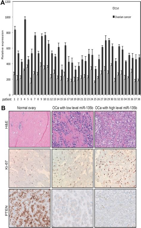 Mir B Level In Human Ovarian Cancer Tissue A Mir B Level In