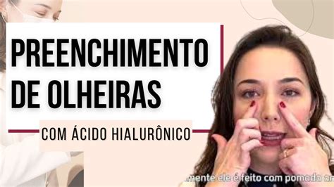 Preenchimento De Olheiras Profundas Cido Hialur Nico Youtube