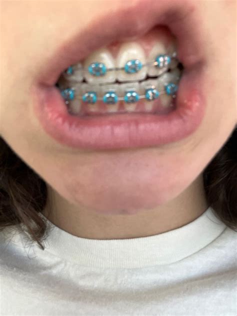 Braces Aesthetic Cute Braces Colors Teeth Braces Dental Braces Colors