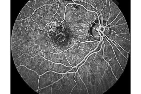 En Face OCT Identifies, Monitors Calcified Drusen in Eyes With Age-Related Macular Degeneration ...