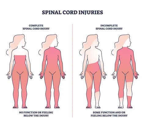 Understanding the Types of Spinal Cord Injuries (SCI) - Neural