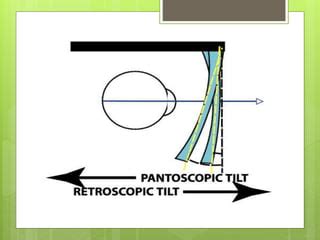 Pantoscopic tilt | PPT