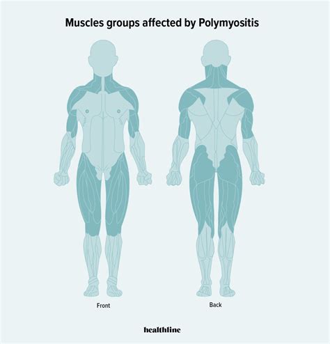 Understanding Polymyositis And Its Effect On Your Body