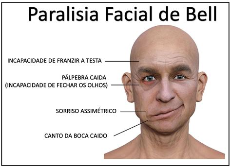Cid Paralisia De Bell - Paralisia de Bell (Paralisia Facial) - Medicina de Excelência