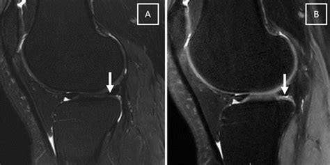 Diagnostic Performance Of Three Dimensional MRI For Depicting Cartilage