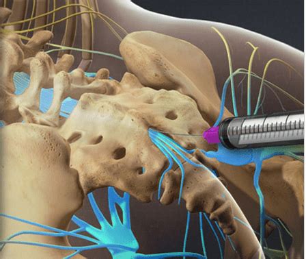 What is an Epidural Injection?: South Lake Pain Institute: Pain Medicine