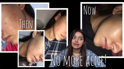 How I Got Rid Of My Acne Hormonal Skincare Journey Youtube