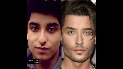 Toni Mahfud Surgery Before After Tonimahfud Youtube