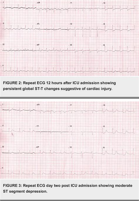 Figure From Takotsubo Syndrome Broken Heart Syndrome Or Stress