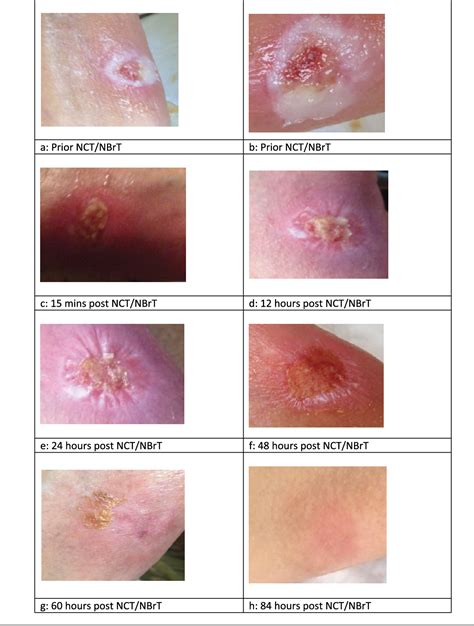 Staph Infection Stages