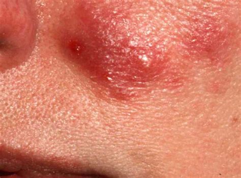 Types Of Rosacea Bumps And Pimples Rosacea Can Often Be C Flickr