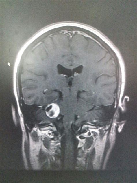 Acoustic neuroma | Mri brain, Brain images, Medical illustration