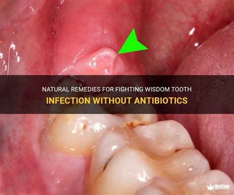 Natural Remedies For Fighting Wisdom Tooth Infection Without Antibiotics | MedShun