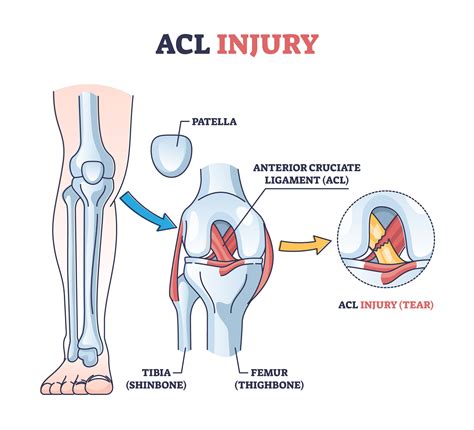 ACL Injury Calgary — Precision Performance & Wellness - Calgary ...