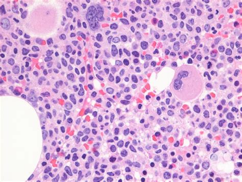 Acute Lymphoblastic Leukemia Bone Marrow Biopsy