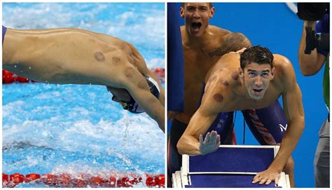 Michael Phelps La Explicaci N De Las Extra As Manchas Negras En Su